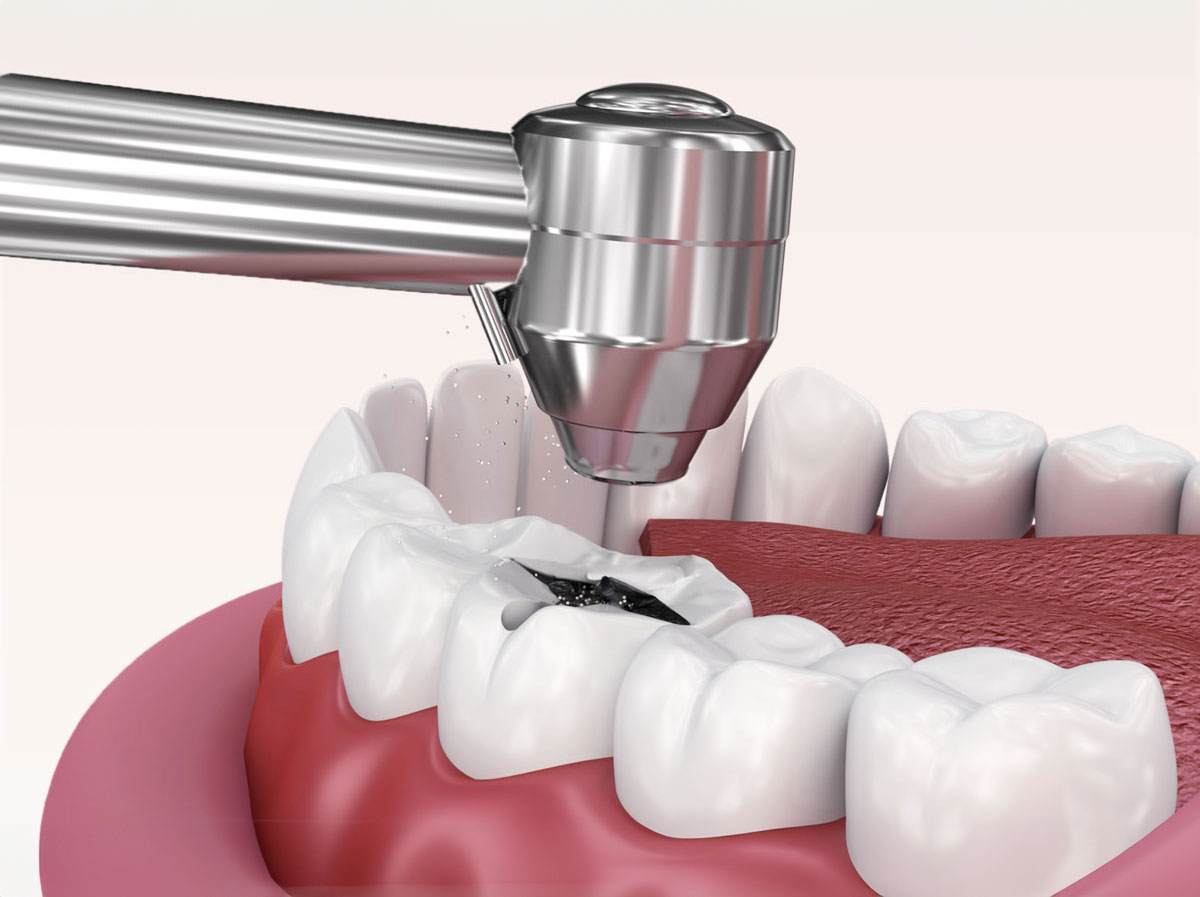 Wurzelbehandlung Horw
